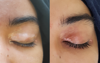 Traitement vasculaire au laser